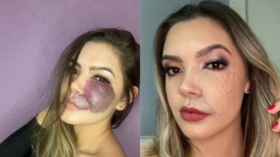 Medo da sociedade me fez encarar um transplante de pele, diz jovem 