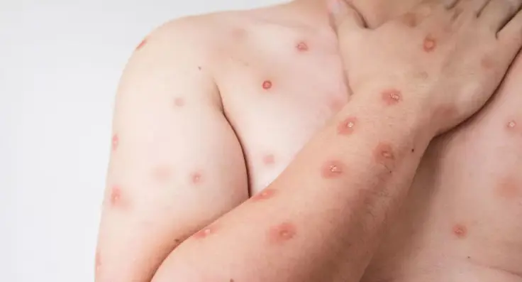 Brasil registra 48 casos de mpox nos primeiros meses de 2026