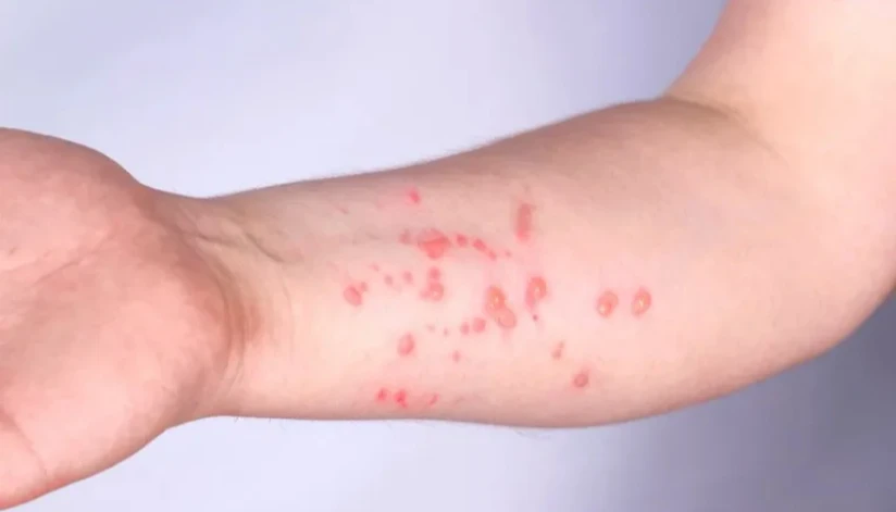 Brasil registra 88 casos de Mpox em 2026; saiba como evitar a doença