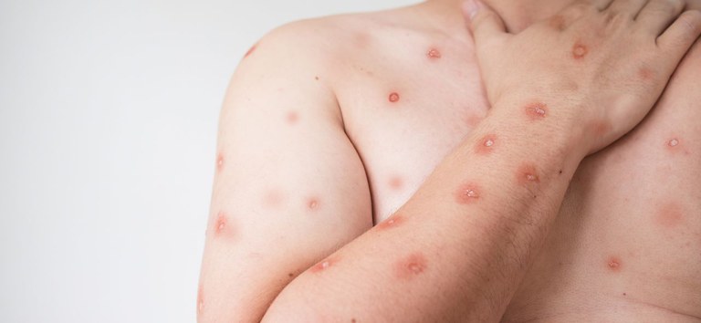 Santos confirma dois casos de mpox em 2026; Estado soma 44 registros neste ano