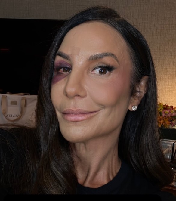 Ivete Sangalo recebe alta após cirurgia no rosto