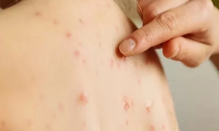 São Paulo confirma segundo caso importado de sarampo em 2026